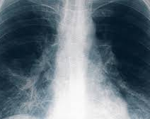 Tucumán: confirmaron una quinta muerte por neumonía causada por la bacteria Legionella