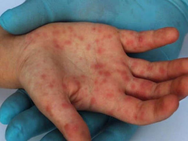 Alerta: Salud evalúa un segundo caso sospechoso de la Viruela del Mono
