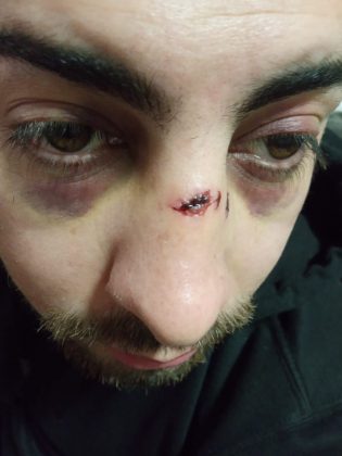 Patovicas sanjuaninos atacaron brutalmente a un joven y lo dejaron en grave estado