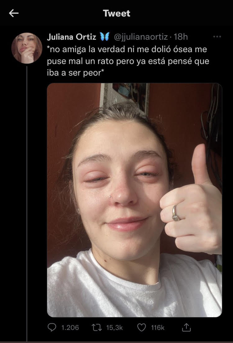 Viral: por una alergia se le deformó la cara y su amiga le hizo un meme