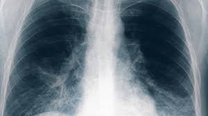 Tucumán: confirmaron una quinta muerte por neumonía causada por la bacteria Legionella