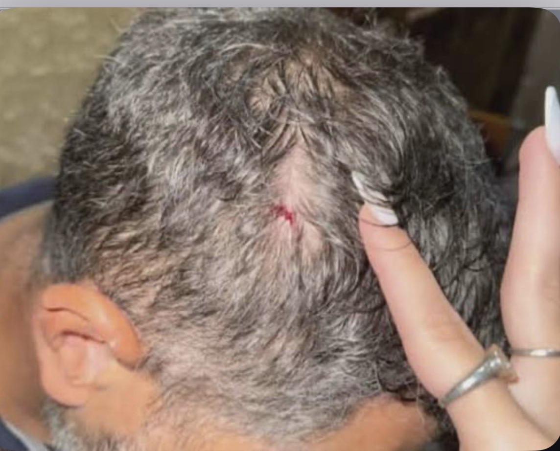 Intentaron asaltarlo en Rawson y lo hirieron con un cuchillo en la cabeza